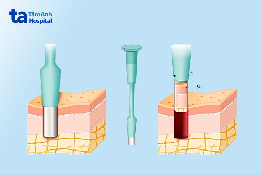 phương pháp điều trị u biểu mô tế bào