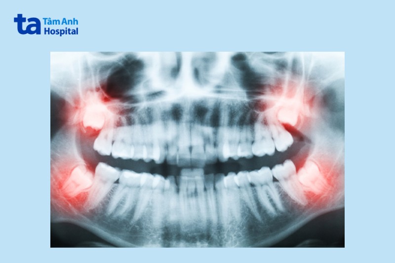 Ai có thể nhổ răng khôn không đau bằng máy siêu âm cao tần Piezotome?