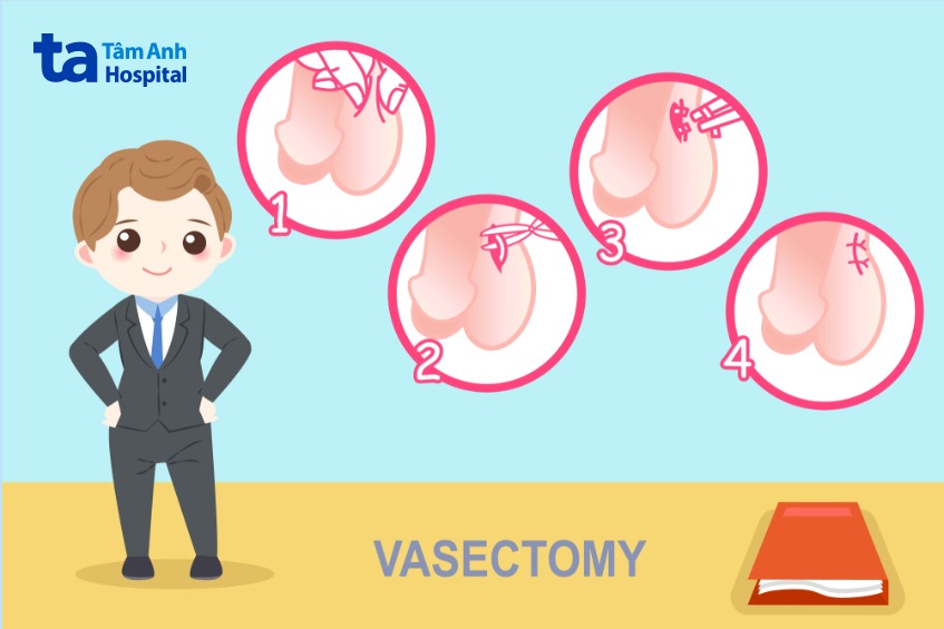 quy trình thắt ống dẫn tinh diễn ra như thế nào