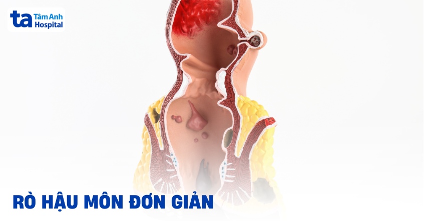 Rò hậu môn đơn giản: Nguyên nhân, triệu chứng và cách điều trị