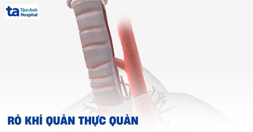 rò khí quản thực quản