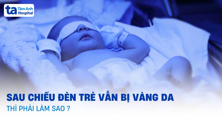 Sau khi chiếu đèn bé vẫn bị vàng da phải làm sao