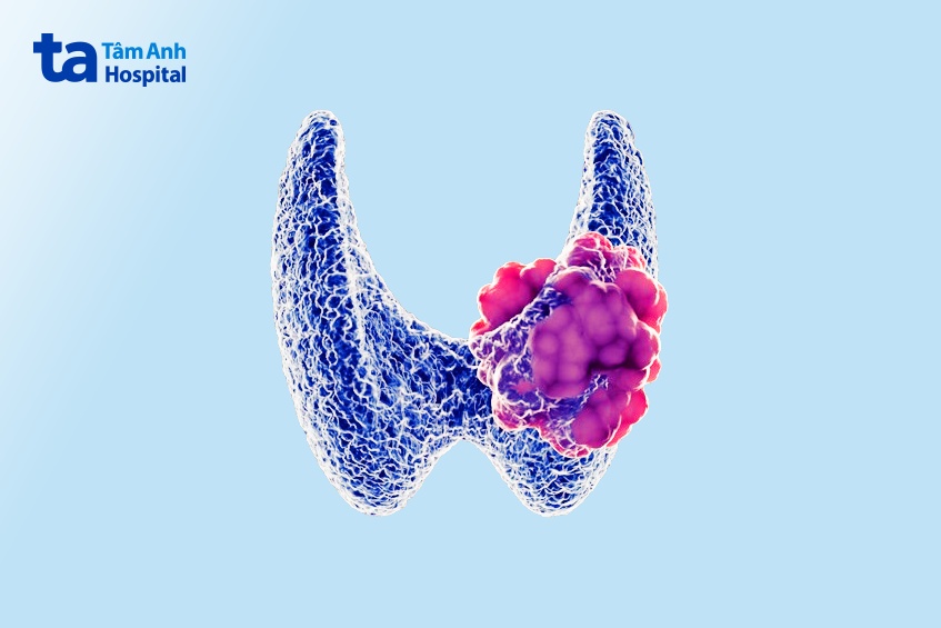 sau phẫu thuật ung thư tuyến giáp có thể gặp biến chứng