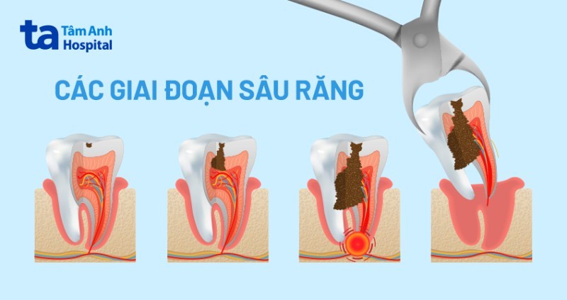 Các vấn đề thường gặp ở răng vĩnh viễn, sâu răng
