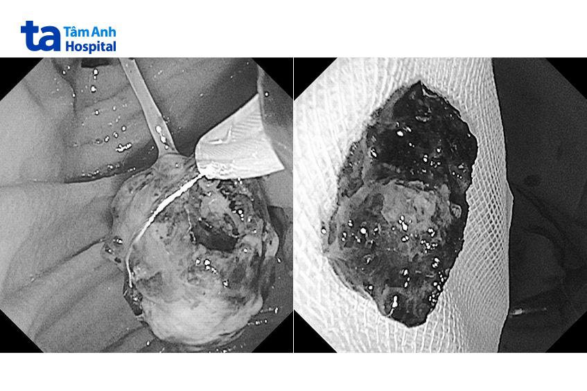 sỏi ống mật chủ lấy ra ngoài