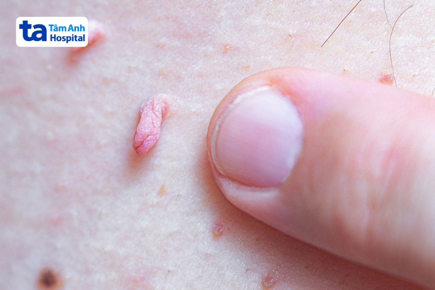 sùi mào gà hiện mụn mềm màu hồng