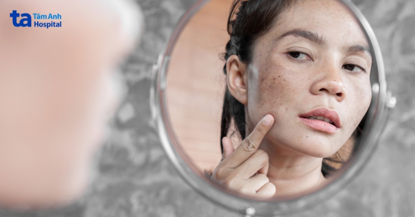 tàn nhang để lâu có sao không