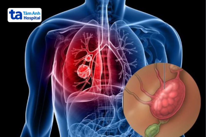 tế bào ung thư di căn trung thất