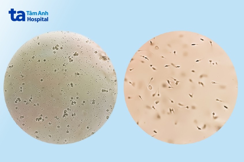 thắt ống dẫn tinh có quan hệ được không