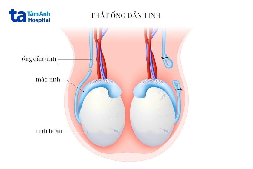 thắt ống dẫn tinh là gì