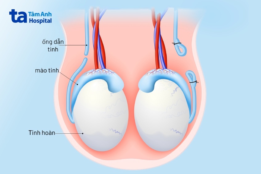 thắt ống dẫn tinh ở nam giới