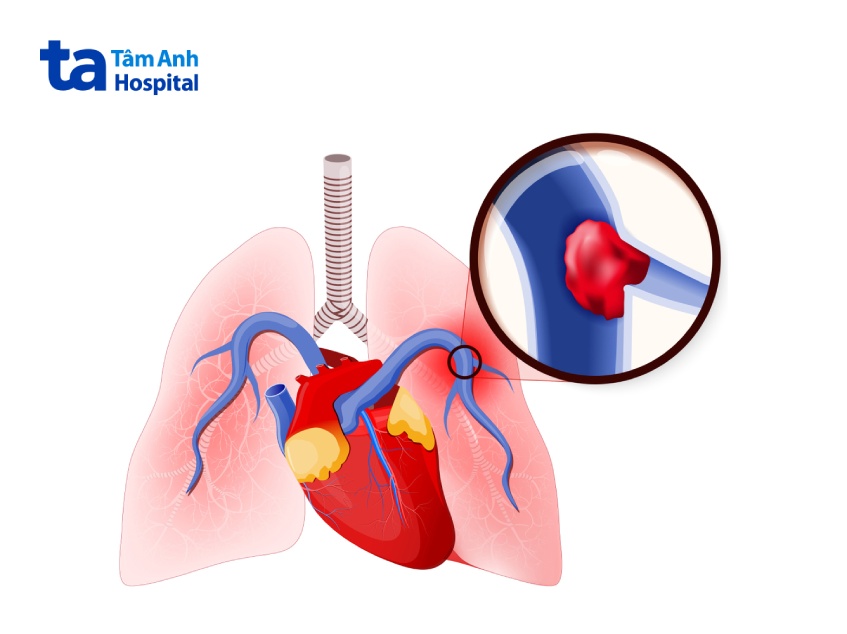 thuyên tắc phổi