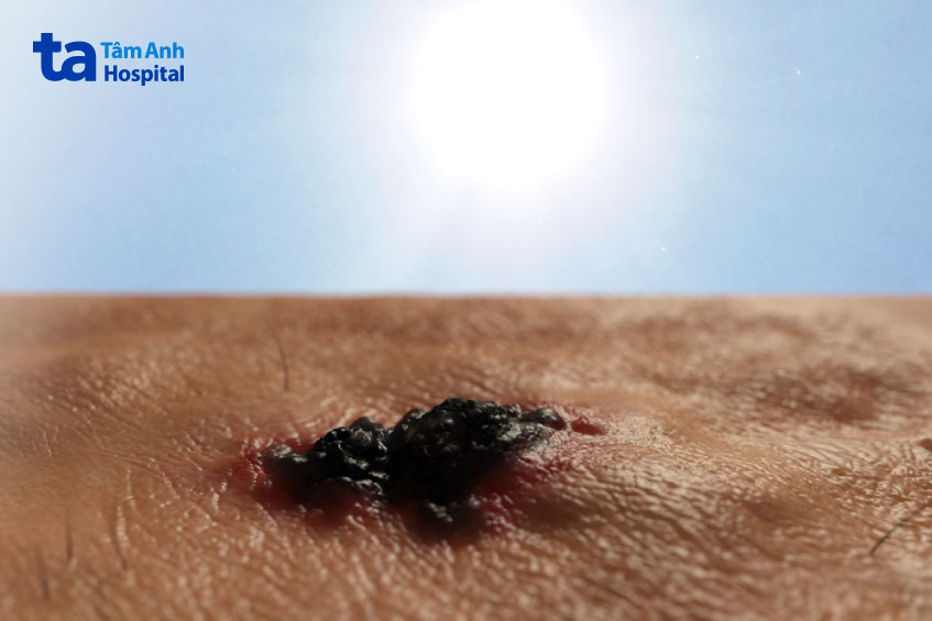 tia uv làm tăng nguy cơ ung thư da