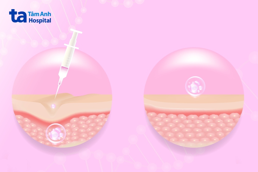 tiêm bap có tác dụng gì