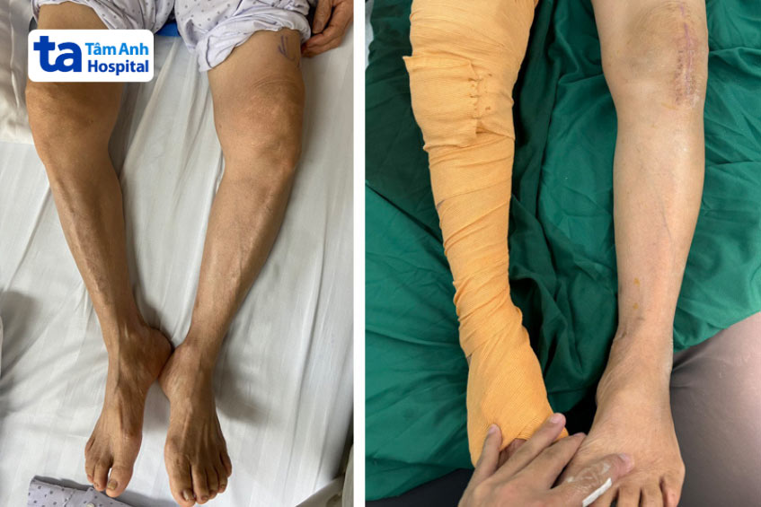Tinh trạng hai chân người bệnh trước và sau phẫu thuật
