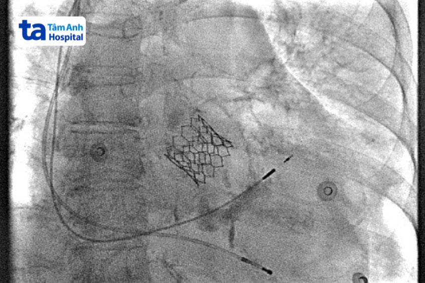 Tình trạng hở van động mạch phổi nặng có thể điều trị bằng cách sửa van hay hoặc thay van