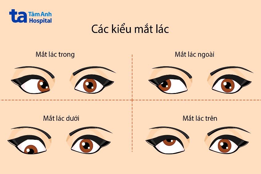 tổng quan về các kiểu mắt lác
