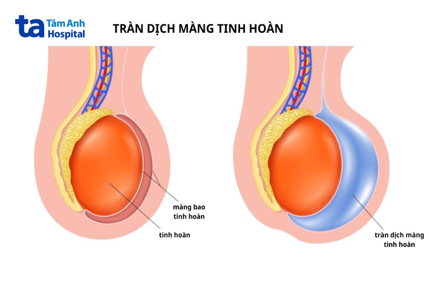 tràn dịch màng tinh hoàn