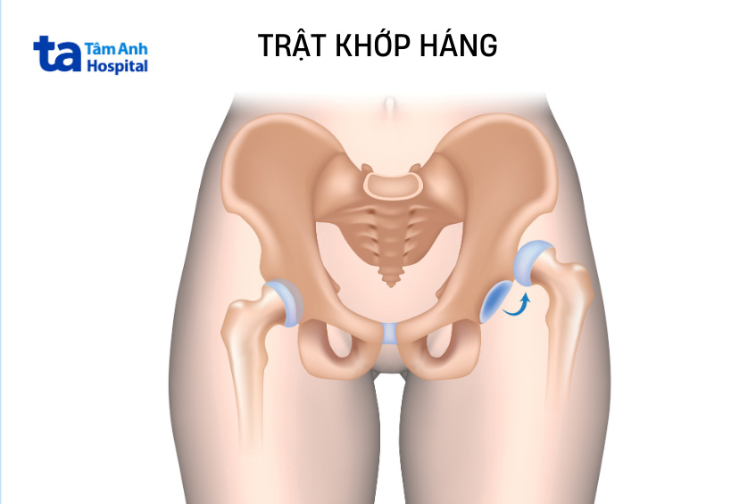 trật khớp háng bao lâu thì khỏi phụ thuộc mức độ tổn thương