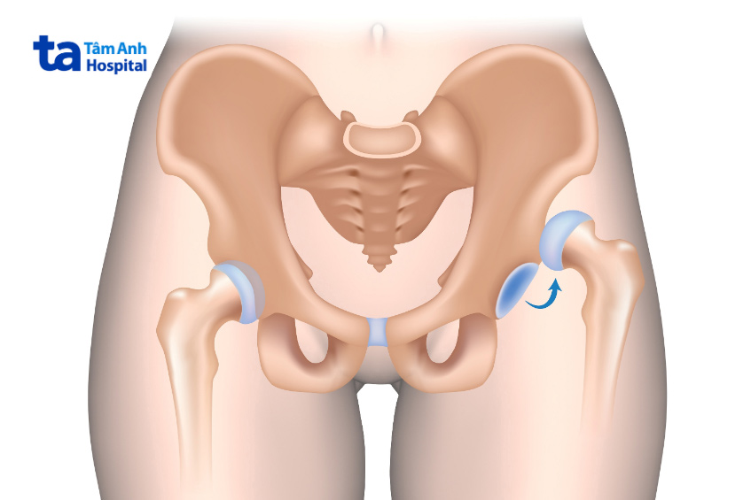 trật khớp háng làm mất khả năng vận động