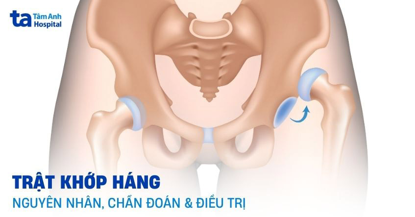 trật khớp háng