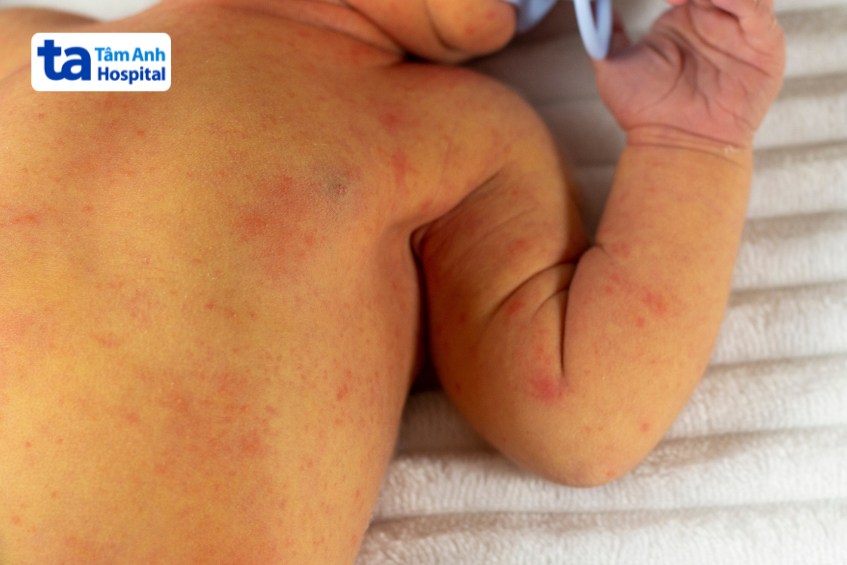 Trẻ sơ sinh bị vàng da cần được đưa đến bệnh viện