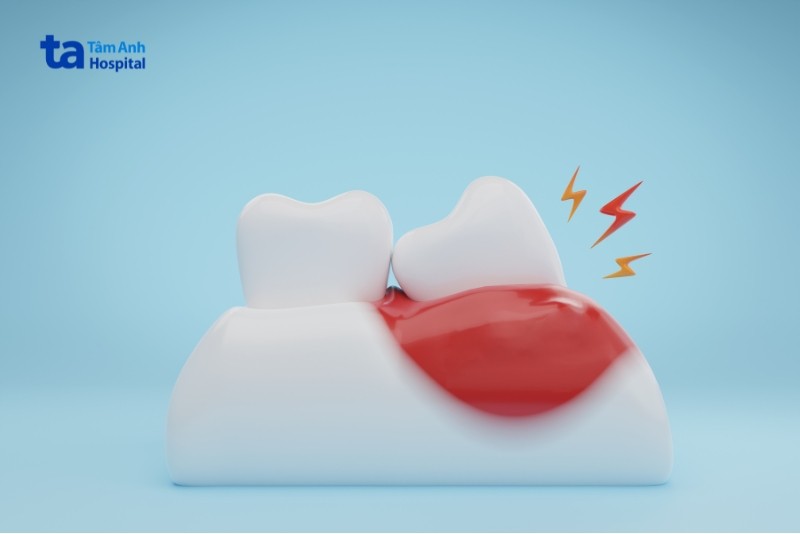 Triệu chứng viêm quanh răng