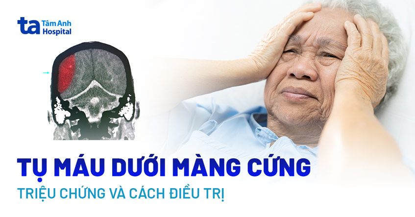 Tụ máu dưới màng cứng: Dấu hiệu, nguyên nhân, chẩn đoán và điều trị