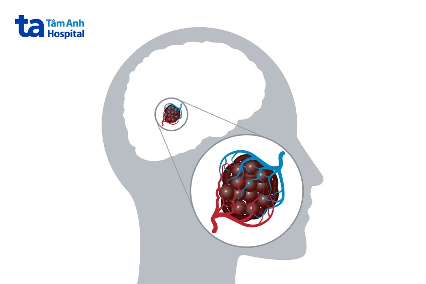 u mạch máu não là gì