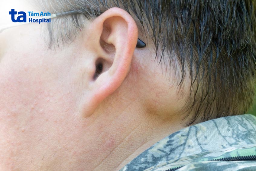 u mỡ phía sau tai