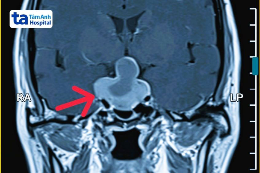 u tuyến yên nằm ở đáy não