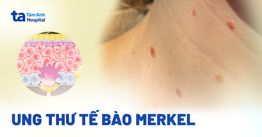 ung thư tế bào merkel