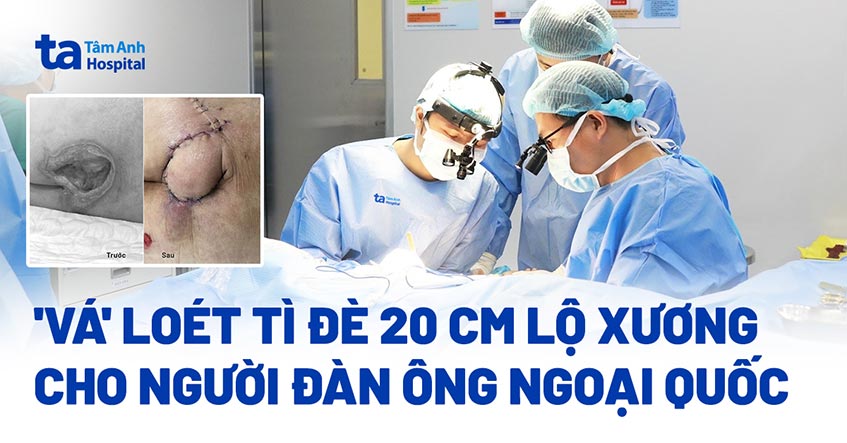 vá loét tì đè 20 cm