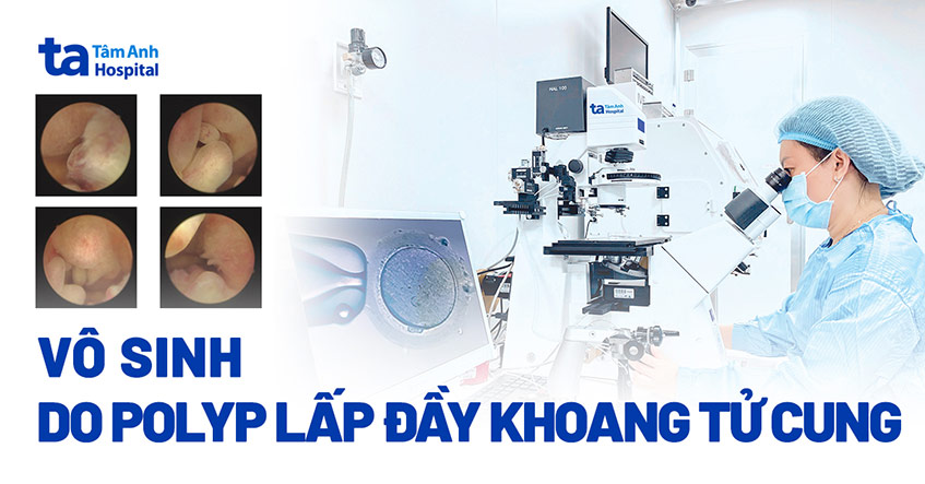 Vô sinh do polyp chi chít lấp đầy khoang tử cung