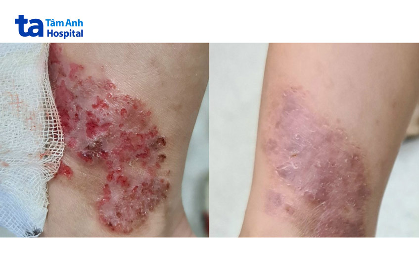 vùng viêm da cơ địa nặng bị bội nhiễm