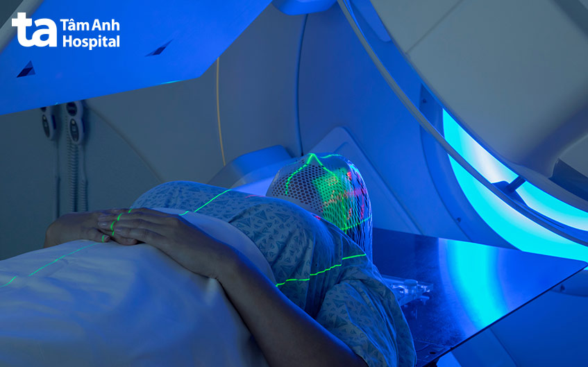 xạ trị điều trị u não giai đoạn cuối