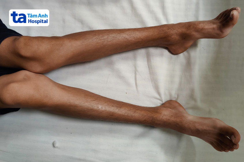 2 đầu gối chụm vào nhau