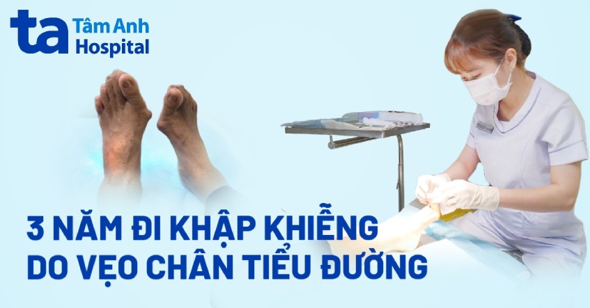 3 năm đi khập khiễng do vẹo chân tiểu đường