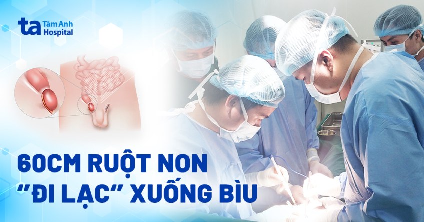 60cm ruột non ‘đi lạc’ xuống bìu
