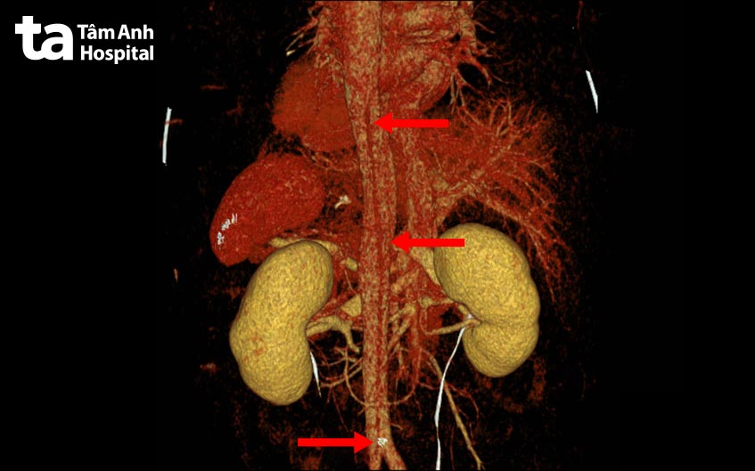 CT-scan dựng hình mạch máu