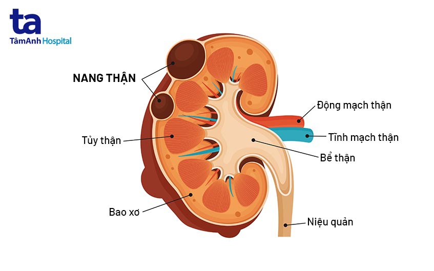 ảnh minh họa nang thận