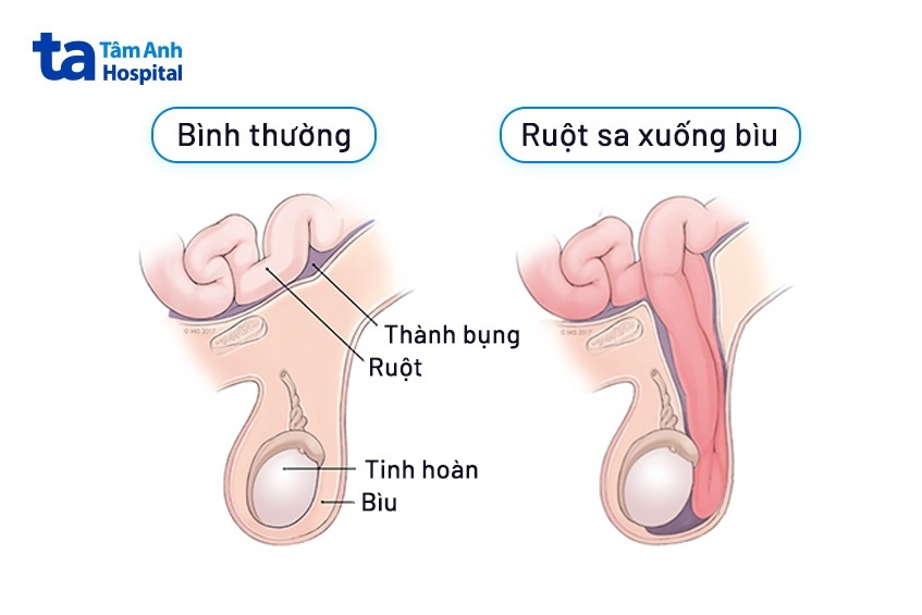 ảnh minh họa thoát vị bẹn