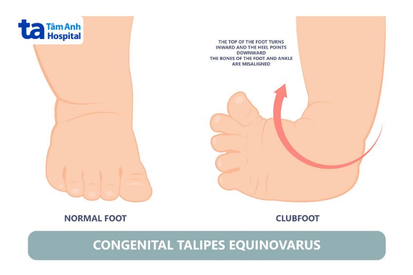 bàn chân khoèo thường xuất hiện trong thời kỳ bào thai