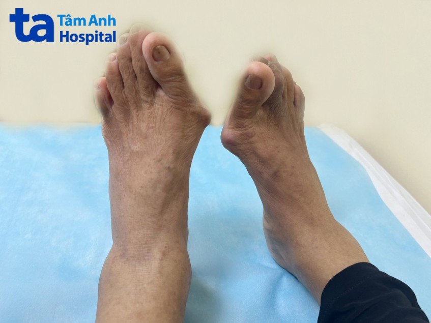 Bàn chân người bệnh tiểu đường bị biến dạng