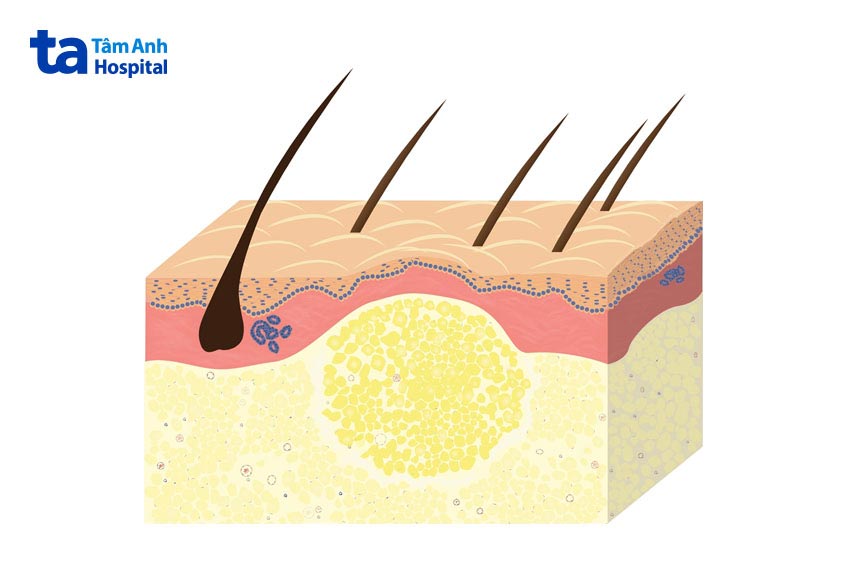 bản chất u mỡ là tế bào mô mỡ tăng sinh bất thường