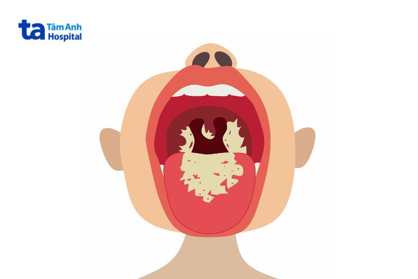 bệnh bạch hầu có lây không