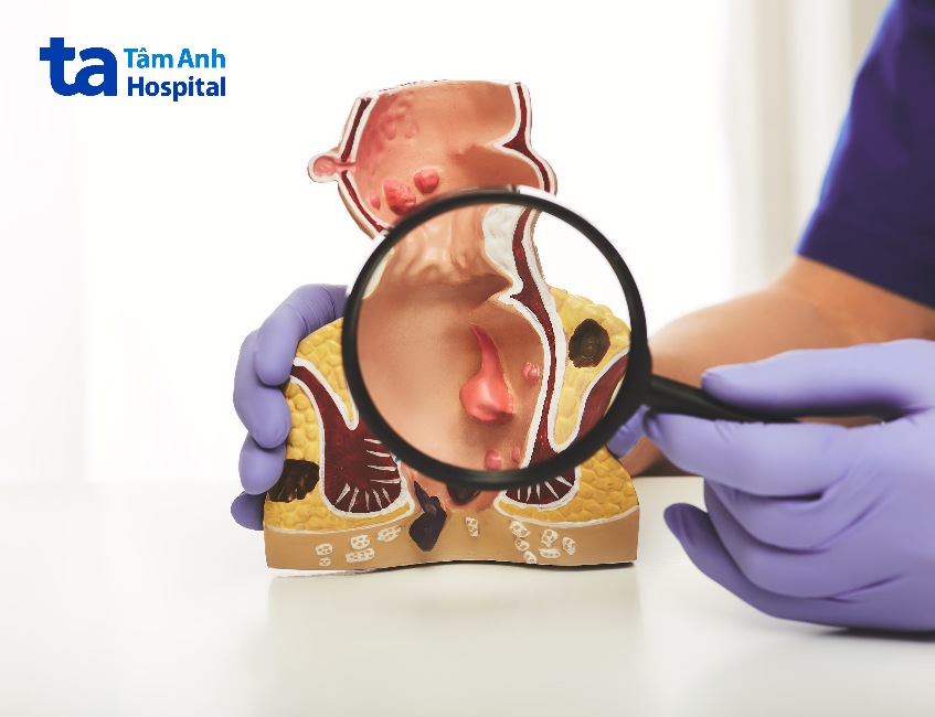 bệnh trí nội tại trực tràng