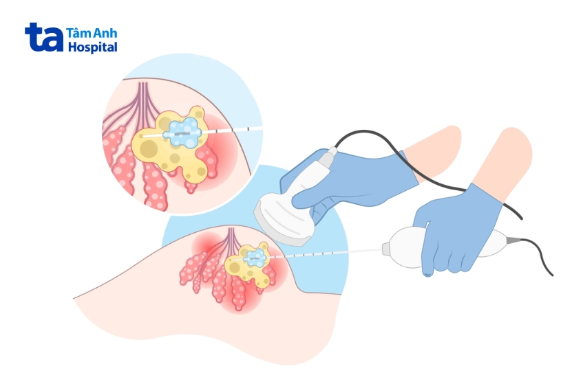 bệnh u xơ tuyến vú