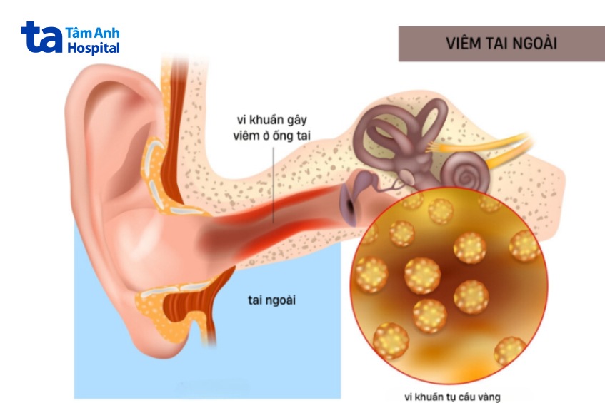 bệnh viêm ống tai ngoài