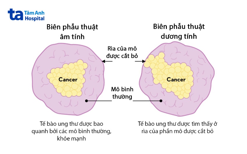 biên cắt phẫu thuật ung thư vú